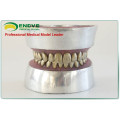 EN-E11 Modelo de práctica de extracción de dientes de dientes de metal para la práctica preoperatoria del médico